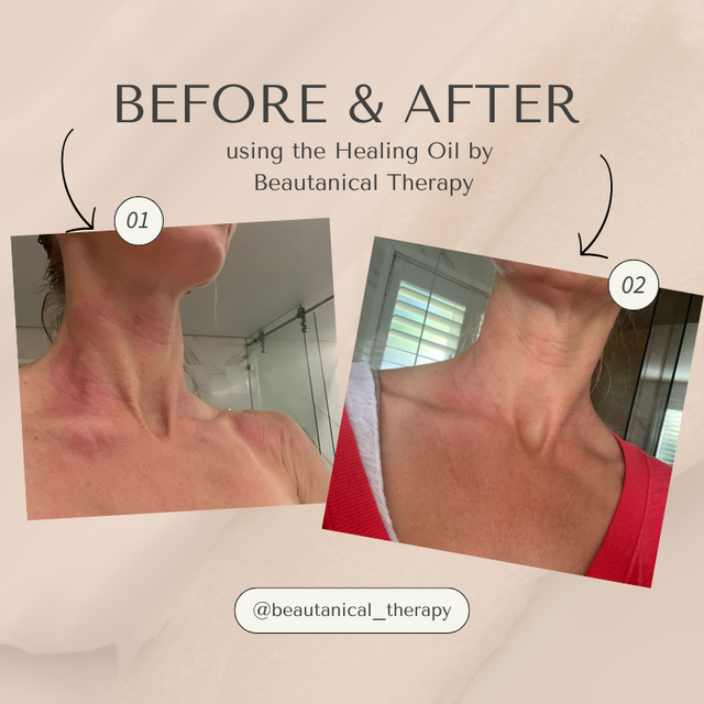 before and after of psoriasis treatment 